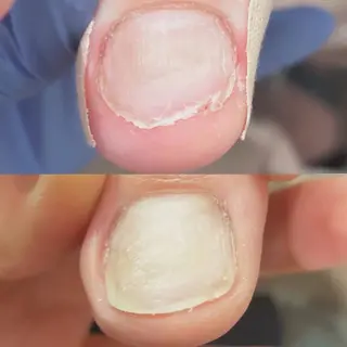 ネイル 自爪育成・巻き爪 補正講師　津蔵のネイルデザイン