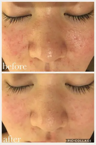 ミディアム パーマ ヘアアレンジ メンズ キッズ ネイル マツエク・マツパ ニキビ・肌質改善専門 ♡人生が変わるサロンのエステ・リラクイメージ