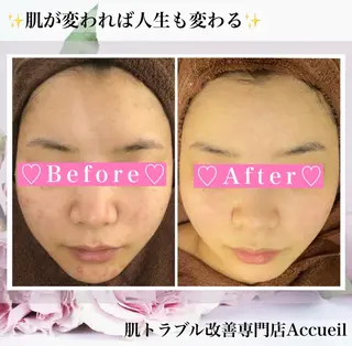 3か月で肌革命👼 ニキビ専門店💫のエステ・リラクイメージ