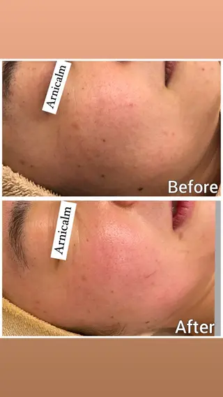 ハーブピーリング 肌再生ピーリング/のエステ・リラクイメージ