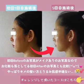 痩身ハーブピーリング 筋膜リリース☆B&Hのエステ・リラクイメージ