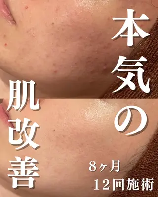 3か月で肌革命👼 ニキビ専門店💫のエステ・リラクイメージ