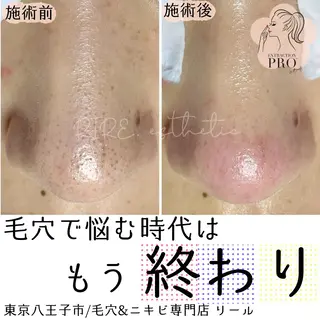 毛穴特化エステ -リールのエステ・リラクイメージ