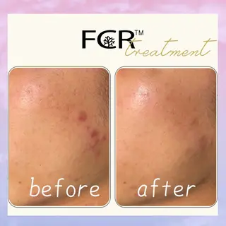 ニキビ 毛穴ケア シャルム ココ みさのエステ・リラクイメージ