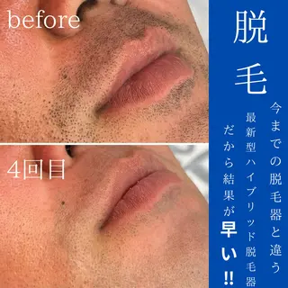WAX・肌質改善・毛 穴洗浄/林愛真のエステ・リラクイメージ