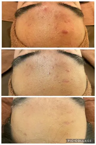 ニキビ経験者が施術 する専門サロン🌻のエステ・リラクイメージ