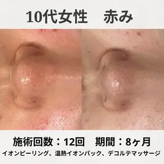 ニキビ跡改善専門🔥 医療にはできない改善のエステ・リラクイメージ