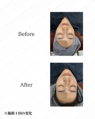 ハーブピーリング🌿 REVI/Ayanoのエステ・リラクイメージ