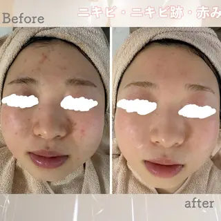 ニキビ&跡改善サロン オーナー光木のエステ・リラクイメージ