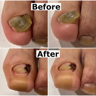 ネイル Mellow nail所属・巻爪無料モデル募集 ✨🦶MEGUMIのネイルデザイン