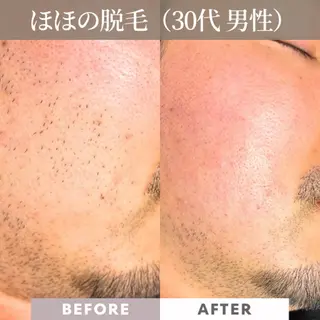 メンズ 【一本ずつ脱毛】 ReMove 柏のエステ・リラクイメージ