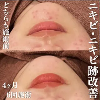 3か月で肌革命👼 ニキビ専門店💫のエステ・リラクイメージ
