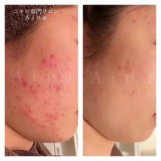 セミロング カラー パーマ ヘアアレンジ メンズ キッズ ネイル マツエク・マツパ アイブロウ ニキビ跡専門サロン Ainaのエステ・リラクイメージ
