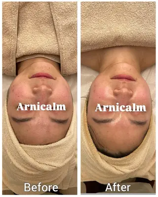 ハーブピーリング 肌再生ピーリング/のエステ・リラクイメージ