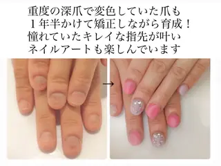 メンズ ネイル 深爪矯正専門店　ネイルサロン　トイロ所属・ネイルサロン トイロのネイルデザイン