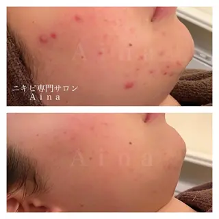 ミディアム カラー パーマ ヘアアレンジ メンズ キッズ ネイル マツエク・マツパ アイブロウ ニキビ跡専門サロン Ainaのエステ・リラクイメージ