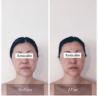 ハーブピーリング 肌再生ピーリング/のエステ・リラクイメージ