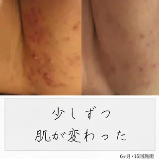 ニキビ経験者が施術 する専門サロン🌻のエステ・リラクイメージ