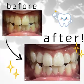 セルフホワイトニング 都立大学🦷✴︎のその他イメージ