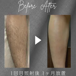 メンズ ecia 脱毛/豊田/浄水のエステ・リラクイメージ