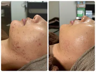 小顔ハーブピーリング 美容鍼/毛穴洗浄のエステ・リラクイメージ