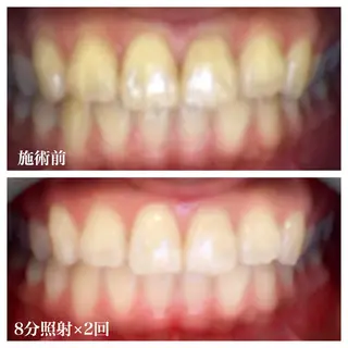 ネイル/耳つぼ /新ホワイトニングのネイルデザイン