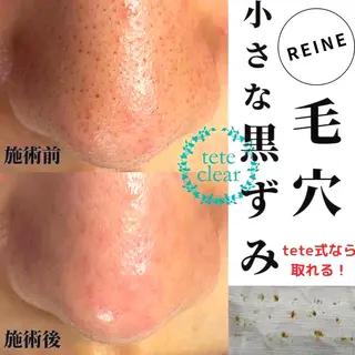 毛穴/シミ肝斑/脱毛 横山梨里のエステ・リラクイメージ