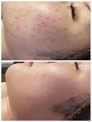 REVITA所属・🆕ハーブピーリング 肌育成のリヴィタのエステ・リラクイメージ