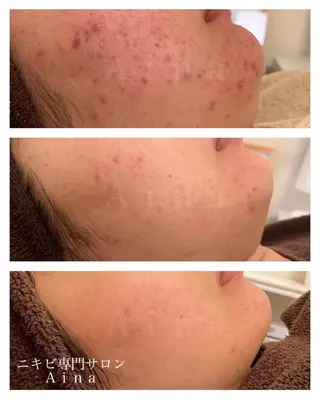 ロング カラー パーマ ヘアアレンジ メンズ キッズ ネイル マツエク・マツパ ニキビ跡専門サロン Ainaのエステ・リラクイメージ
