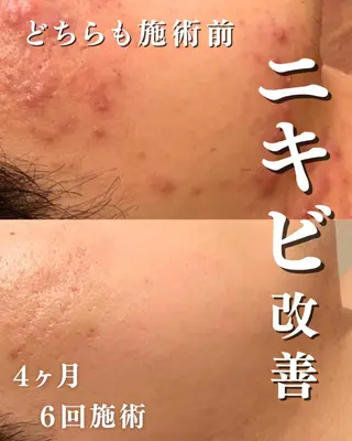 ニキビ跡改善専門🔥 医療にはできない改善のエステ・リラクイメージ