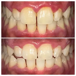 ルミナホワイト セルフホワイトニングのその他イメージ