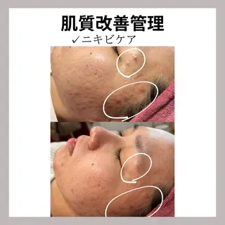 WAX・肌質改善・毛 穴洗浄/林愛真のエステ・リラクイメージ