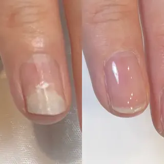 自爪育成・巻き爪 補正講師　津蔵のネイルデザイン