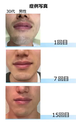 メンズ MERAVI 🫧🌿のマツエク・マツパデザイン