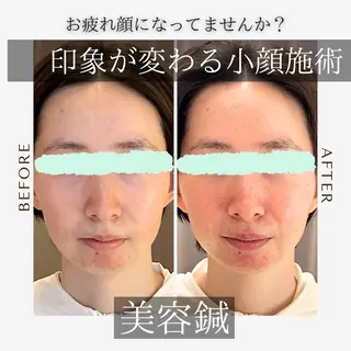 《美肌･小顔》美容鍼 ＆マッサージ＊MEIのエステ・リラクイメージ
