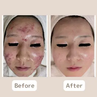 〈ニキビケアサロン〉 レゾン京橋店/ 浅川のエステ・リラクイメージ