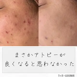 ニキビ経験者が施術 する専門サロン🌻のエステ・リラクイメージ