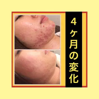 ミディアム パーマ ヘアアレンジ キッズ ネイル マツエク・マツパ ニキビ・肌質改善専門 ♡人生が変わるサロンのエステ・リラクイメージ