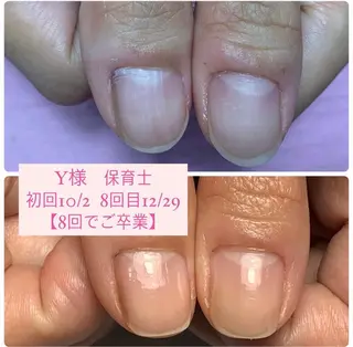 ネイル 自爪育成/深爪矯正 mikiのネイルデザイン