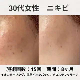 ニキビ跡改善専門🔥 医療にはできない改善のエステ・リラクイメージ
