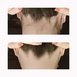 【医療提携】脱毛 小顔ハーブピーリングのエステ・リラクイメージ