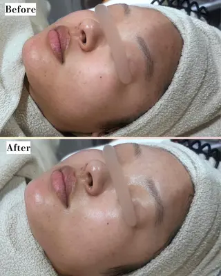 |ピーリング・毛穴| soina神楽坂のエステ・リラクイメージ