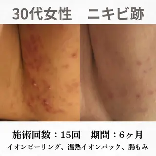 重度ニキビ専門🌷 ダウンタイムなしのエステ・リラクイメージ