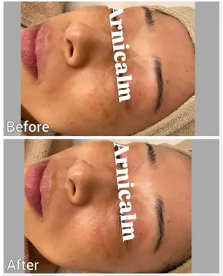 ハーブピーリング 肌再生ピーリング/のエステ・リラクイメージ