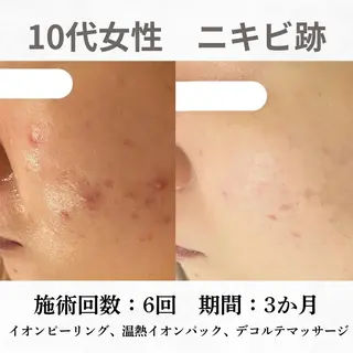 重度ニキビ専門🌷 ダウンタイムなしのエステ・リラクイメージ