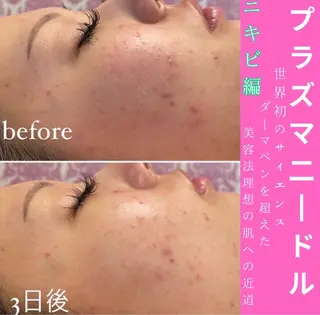 WAX・肌質改善・毛 穴洗浄/林愛真のエステ・リラクイメージ
