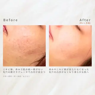 繰り返すニキビ・毛穴 ✨つくば肌質改善専門のエステ・リラクイメージ