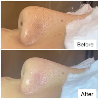 ielu〜毛穴ケア ハーブピーリングのエステ・リラクイメージ