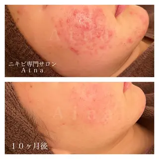 セミロング カラー パーマ ヘアアレンジ メンズ キッズ ネイル マツエク・マツパ アイブロウ ニキビ跡専門サロン Ainaのエステ・リラクイメージ