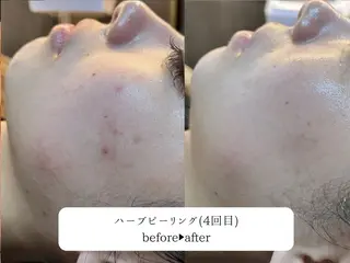 ニキビ・ニキビ跡改善 leoloのエステ・リラクイメージ